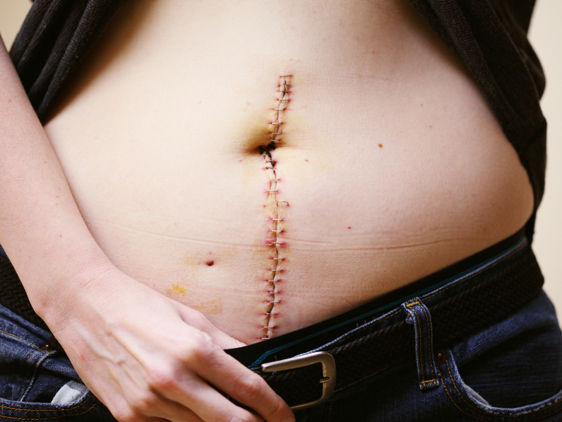 How to Fade A Laparotomy Scar Naturally and Feel Confident